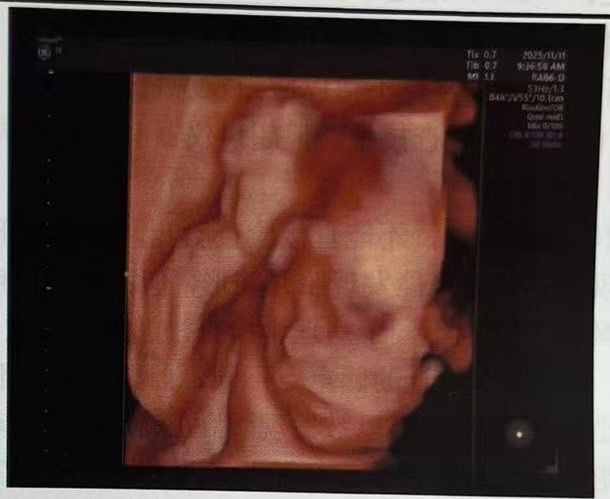 4D ultrasound fetal facial image